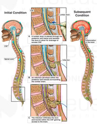 Progression of Meningitis Following Lumbar CSF Leak