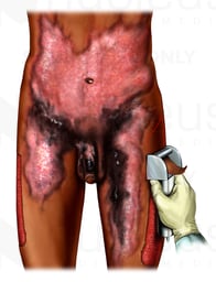 Severe Burn Debridement