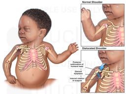 Birth Injury - Shoulder Dislocation