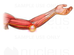Ulnar Nerve Impingement