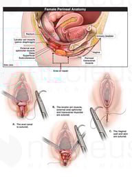 Layered Repair of Fourth Degree Perineal Laceration