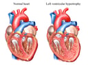 Normal Heart Anatomy vs Left Ventricular Hypertrophy