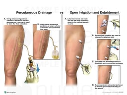 Percutaneous Drainage vs. Open Irrigation and Debridement