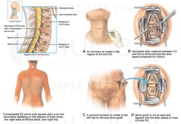 C3-4, C4-5 Cervical Spine Injuries with Surgical Discectomy and Fusion