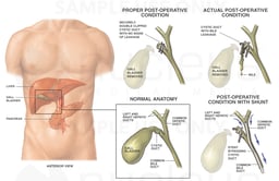 Failed Cholecystectomy with Leaking Cystic Duct
