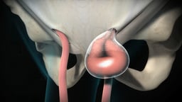 Inguinal Hernia