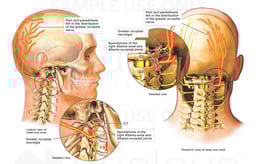 Male Head and Neck with Post-accident Facet Syndrome and Occipital Neuralgia