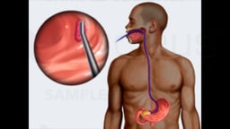 Upper GI Endoscopy for Gastric Ulcer