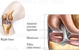Anterior Cruciate Ligament (ACL)