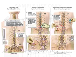 Spinal Cord Stimulator Placement
