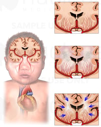 Brain Injury - Hypoxia Ischemia Due to Periventricular Leukomalacia (PVL)