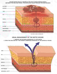 Septic Surgical Wound Management