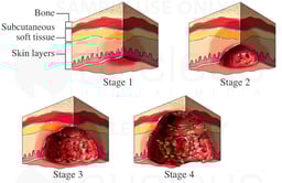 Pressure Sores: Four Stages