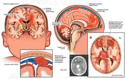 Superior Sagittal Sinus Thrombosis with Intracranial Hemorrhage