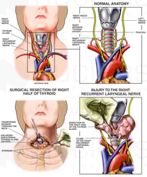 Thyroidectomy with Iatrogenic Laryngeal Nerve Resection