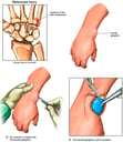 Right Wrist Injury with Surgical Excision of Ganglion Cyst