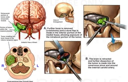 Brain Surgery - Removal of Intracranial Brain Tumor