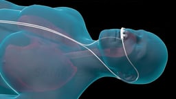 Nasal Cannula Placement
