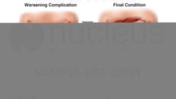 Barnett Continent Intestinal Reservoir (BCIR) and Post-operative Leakage