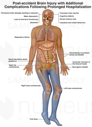 Post Accident Brain Injury