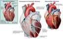 Coronary Artery Disease with Subsequent Heart Damage