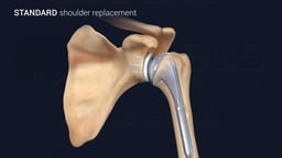 Standard Shoulder Replacement Procedure