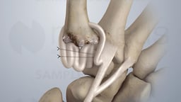 Trapeziectomy with Ligament Reconstruction and Tendon Interposition (LRTI) for Osteoarthritis of the Thumb