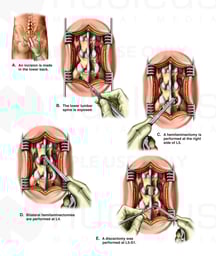Decompression Laminectomies and Discectomy