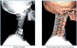 Lateral View of Post-operative Condition of the Cervical Spine Following Fusion