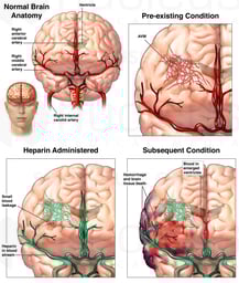 Rupture of Cerebral Arteriovenous Malformation (AVM)
