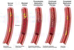 Thrombolytic Therapy