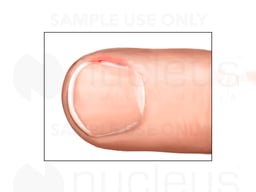 Hangnail