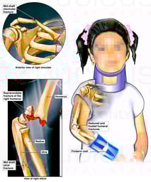 Right Arm Fractures with Surgical Fixation