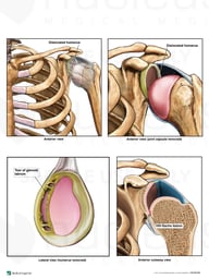 Left Shoulder Sports Injuries