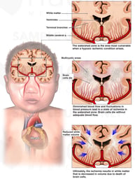 Brain Injury - Hypoxia Ischemia Due to Periventricular Leukomalacia (PVL)