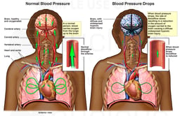 Reduced Blood Pressure with Diffuse Hypoxic Brain Injury