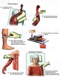 Multiple Burn Debridement and Skin Grafting Procedures