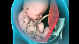 Breech Birth Position - 3D Rotation