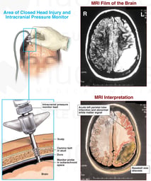 Traumatic Closed Head Injuries and Placement of Intracranial Pressure Monitor