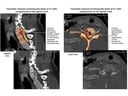 Traumatic Fracture of the C7 Vertebral Body and Subsequent Spinal Injuries