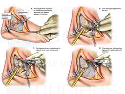 Radiofrequency Ablations