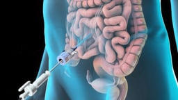 Laparoscopic Lysis of Abdominal Adhesions