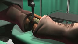 Below the Knee Surgical Amputation