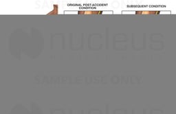 Right Elbow Injury with Surgeries