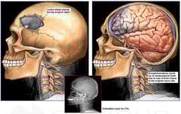 Skull Fracture with resulting Brain Damage