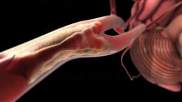 Carotid Artery Disease