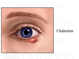 Chalazion