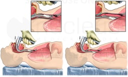 Correct (Endotracheal) vs. Incorrect (Esophageal) Intubation