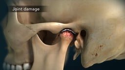 Temporomandibular Joint (TMJ) with Damage from Arthritis