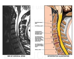 Whiplash Injury - C4-5, C5-6 and C6-7 Cervical Intervertebral Disc Herniations